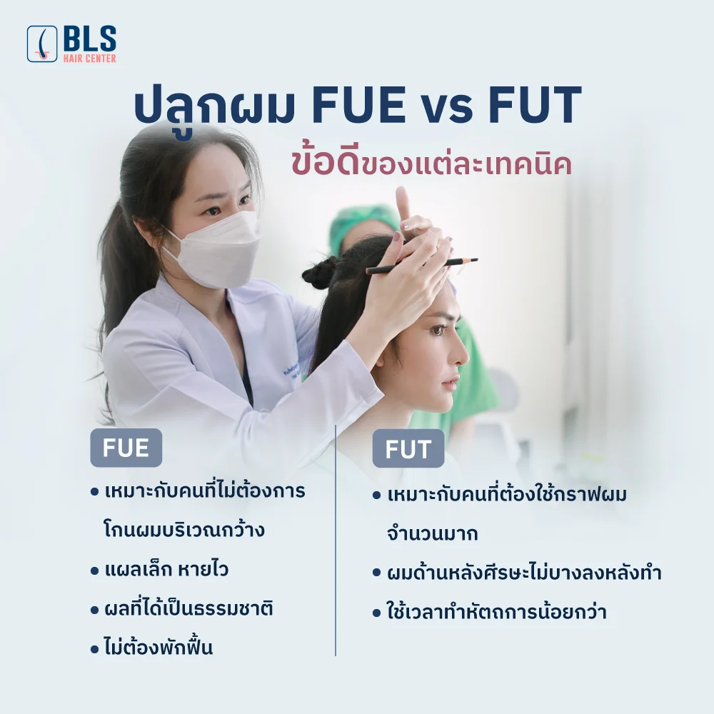 ปลูกผม FUE vs FUT ข้อดีของแต่ละเทคนิค