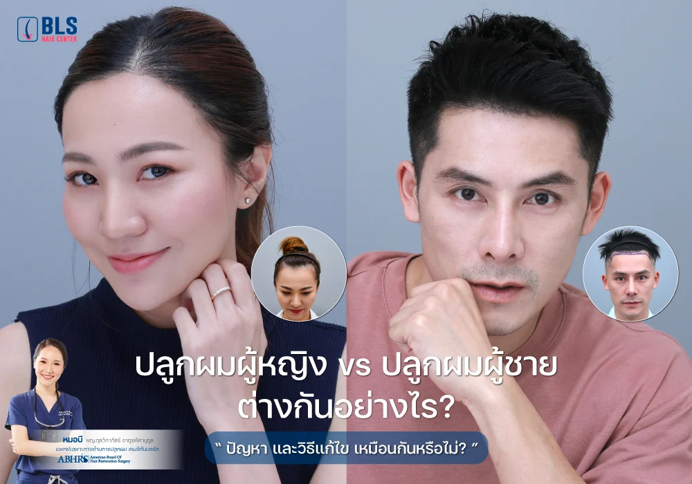 ปลูกผมผู้หญิง vs ปลูกผมผู้ชาย ต่างกันอย่างไร?