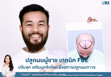 ปลูกผม FUE ปรับลุค เสริมบุคลิกใหม่ ด้วยการปลูกผมถาวร