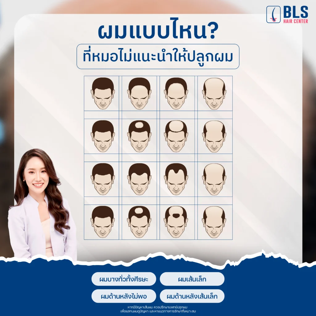 ลักษณะผมแบบไหนบ้าง? ที่หมอไม่แนะนำให้ปลูกผม