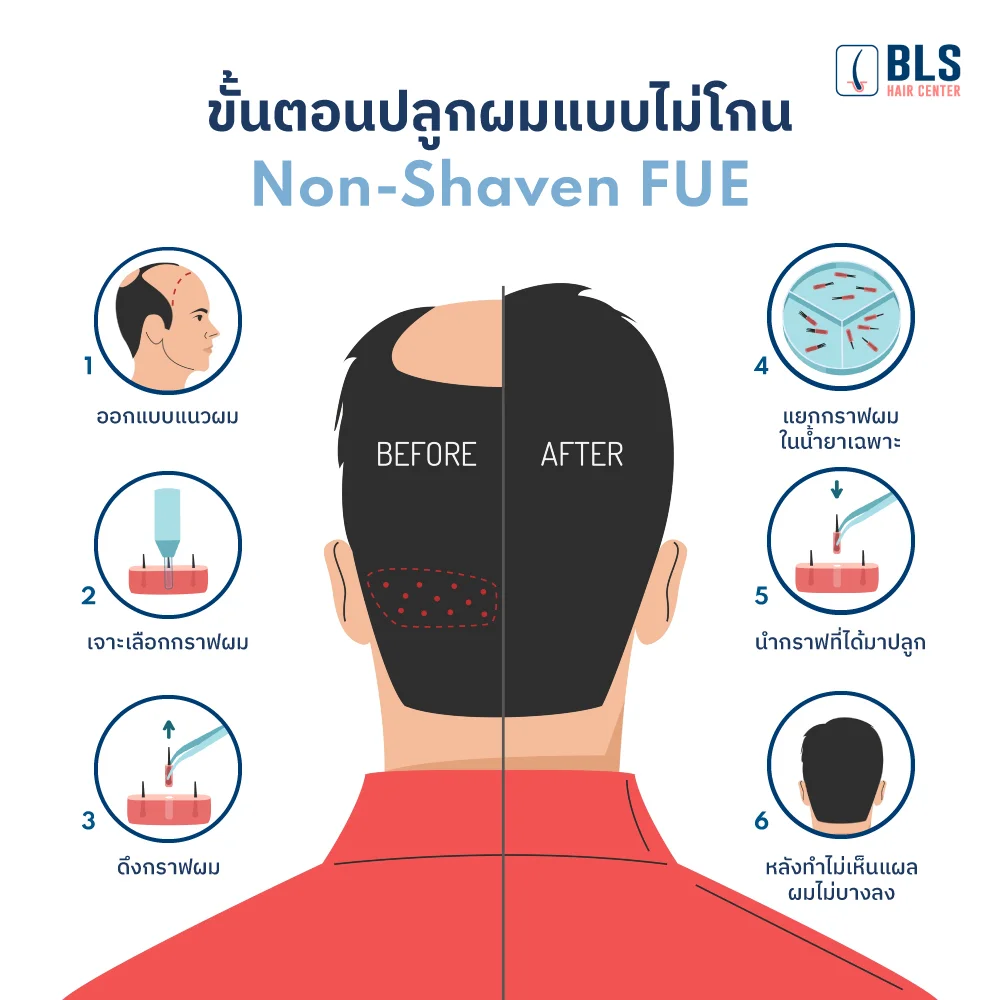 ขั้นตอนการปลูกผม  ด้วยเทคนิค Non Shaven FUE ปลูกผมไม่ต้องโกน