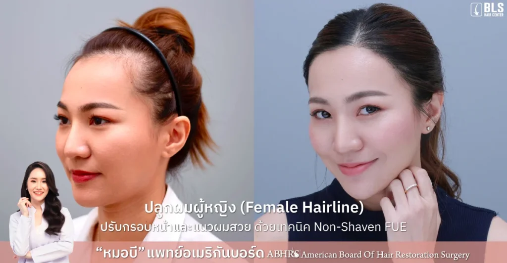 ปลูกผมผู้หญิง หน้าผากเถิก ปรับกรอบหน้าและแนวผมสวย ด้วยเทคนิค Non-Shaven FUE