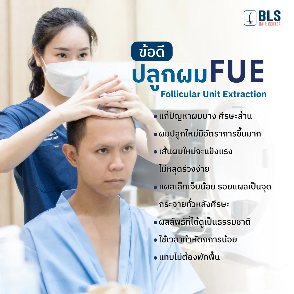 ข้อดีของการปลูกผม FUE