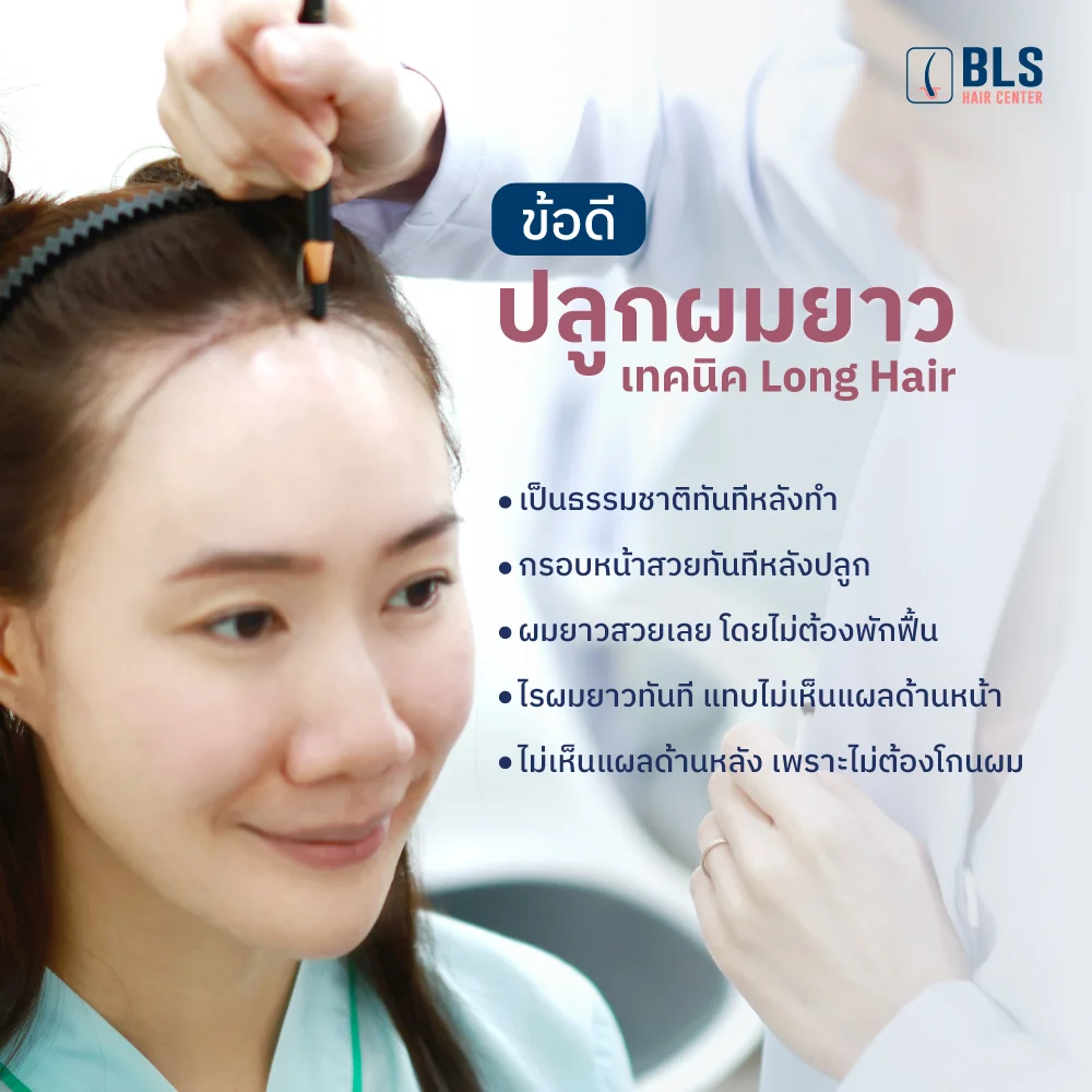 ข้อดีของการปลูกผมยาว (เทคนิค Long Hair)