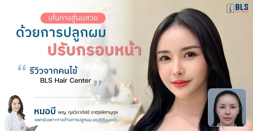 รีวิวปลูกผมถาวร