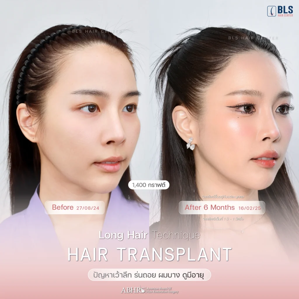 Review ปลูกผมผู้หญิง ที่ BLS Hair Center ปลูกผมถาวร รักษาผมร่วง ผมบาง โดยแพทย์อเมริกันบอร์ด