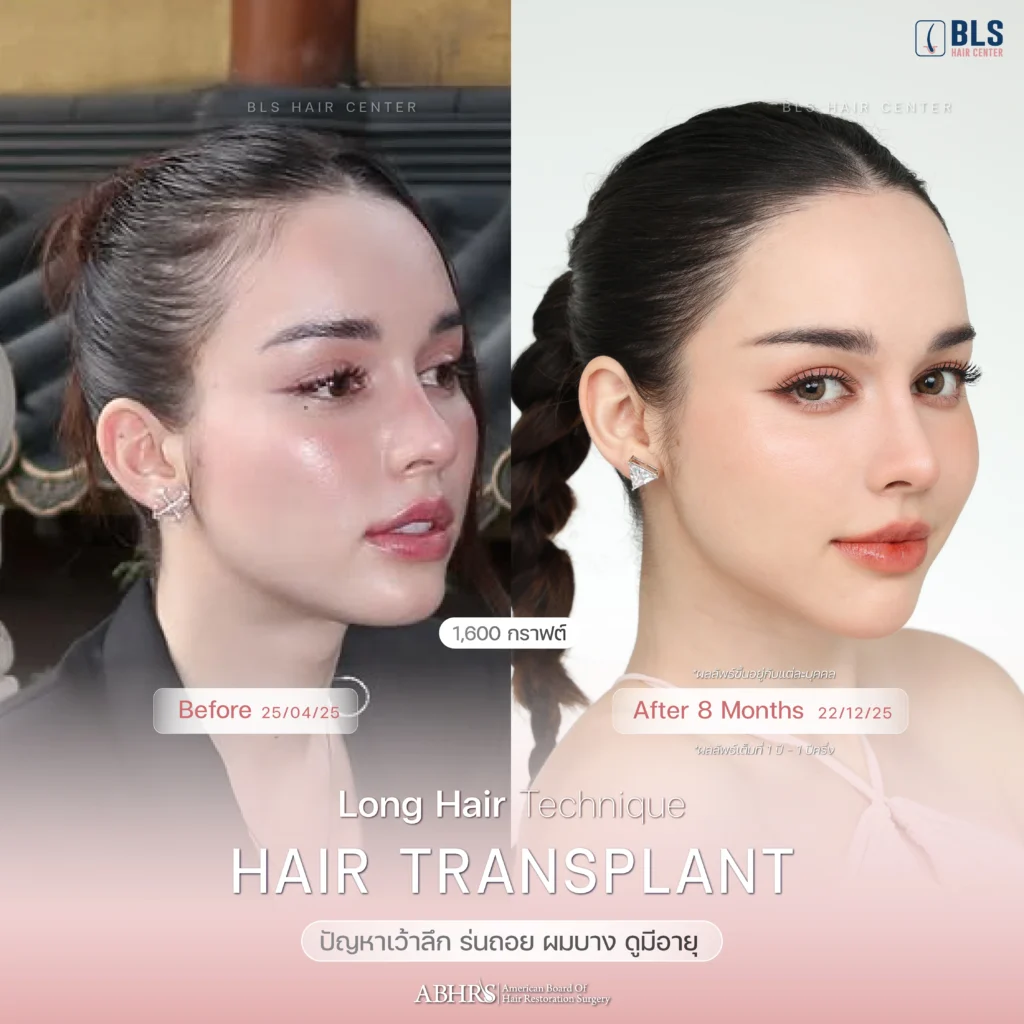 Review ปลูกผมผู้หญิง ที่ BLS Hair Center ปลูกผมถาวร รักษาผมร่วง ผมบาง โดยแพทย์อเมริกันบอร์ด