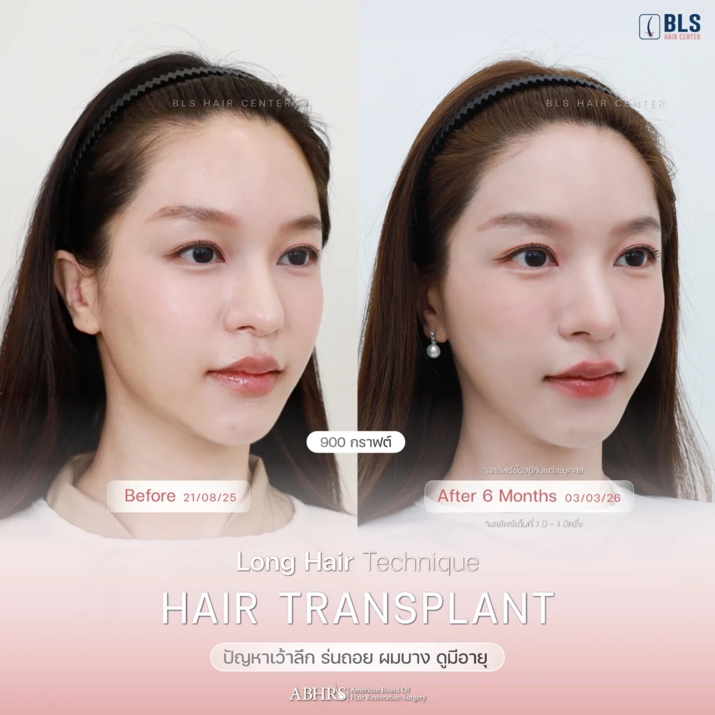 Review ปลูกผมผู้หญิง ที่ BLS Hair Center ปลูกผมถาวร รักษาผมร่วง ผมบาง โดยแพทย์อเมริกันบอร์ด