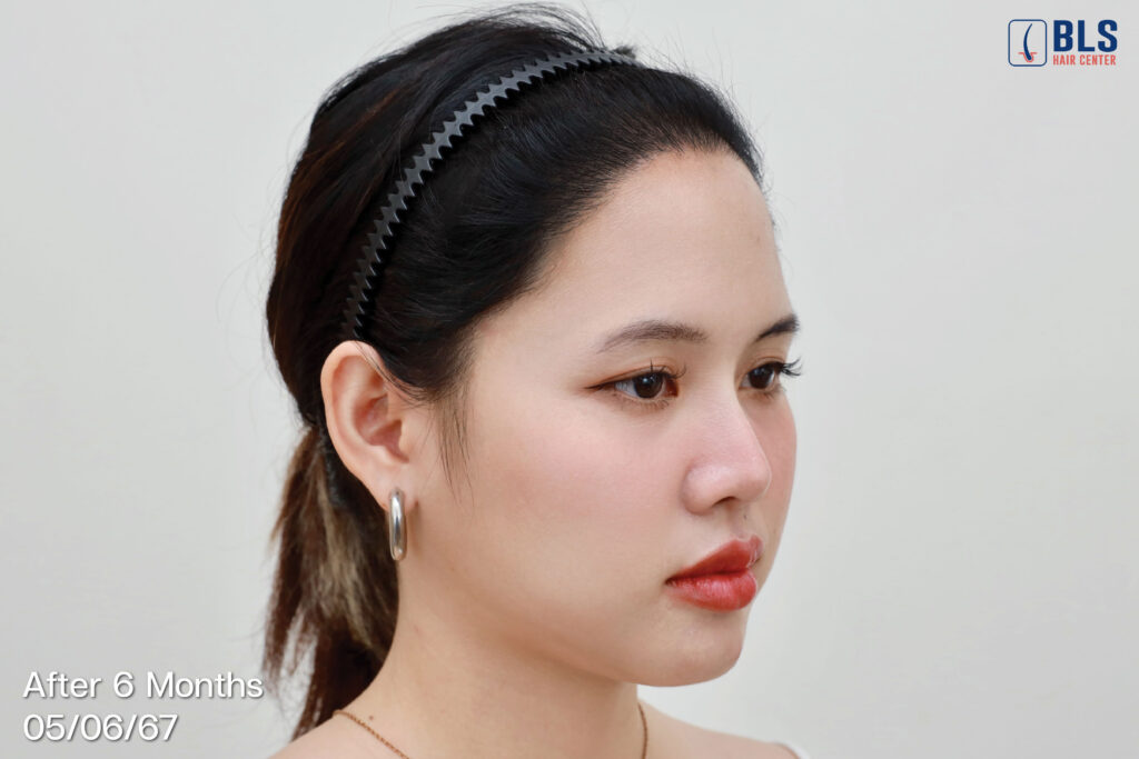 ปลูกผมผู้หญิง (Female Hairline)