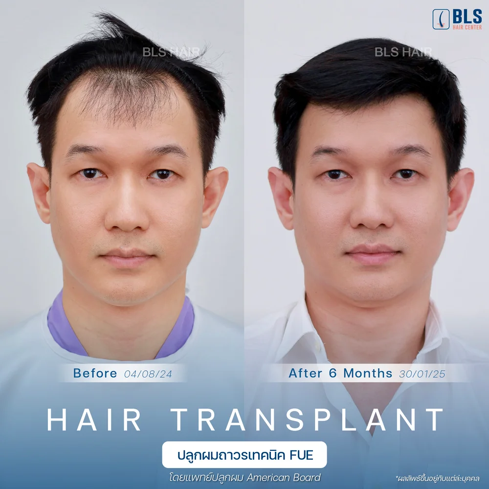 รีวิวปลูกผมผู้ชาย ผมบางกลับมาหนา ผลลัพธ์ธรรมชาติ ที่ BLS Hair Center