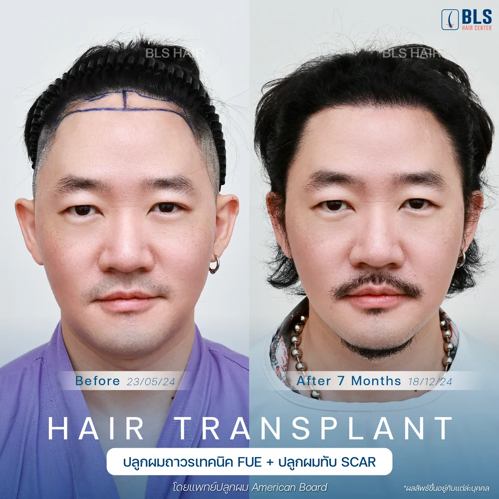 รีวิวปลูกผมผู้ชาย ผมบางกลับมาหนา ผลลัพธ์ธรรมชาติ ที่ BLS Hair Center