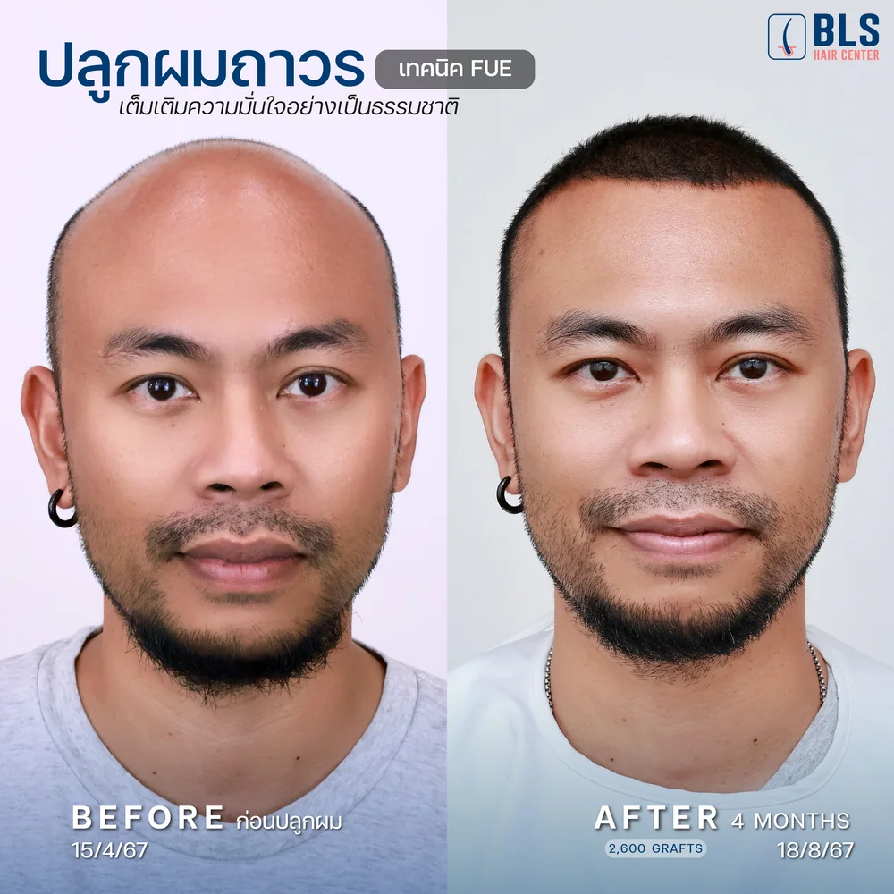 รีวิวปลูกผมผู้ชาย ผมบางกลับมาหนา ผลลัพธ์ธรรมชาติ ที่ BLS Hair Center