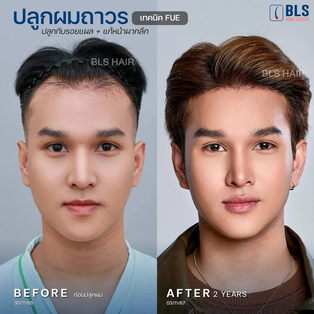 รีวิวปลูกผมผู้ชาย ผมบางกลับมาหนา ผลลัพธ์ธรรมชาติ ที่ BLS Hair Center