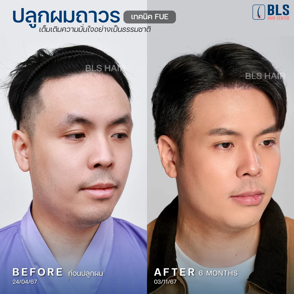 รีวิวปลูกผมผู้ชาย ผมบางกลับมาหนา ผลลัพธ์ธรรมชาติ ที่ BLS Hair Center