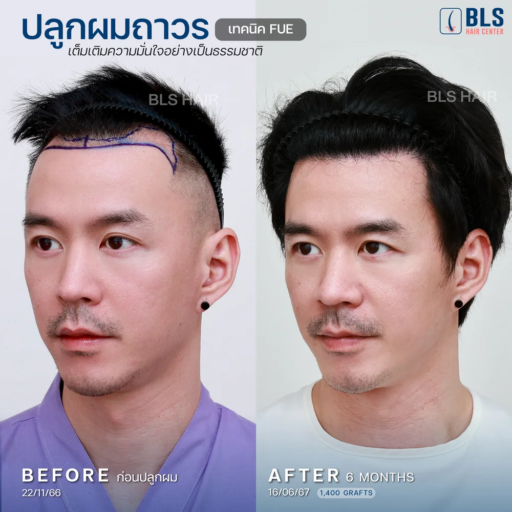 รีวิวปลูกผมผู้ชาย ผมบางกลับมาหนา ผลลัพธ์ธรรมชาติ ที่ BLS Hair Center