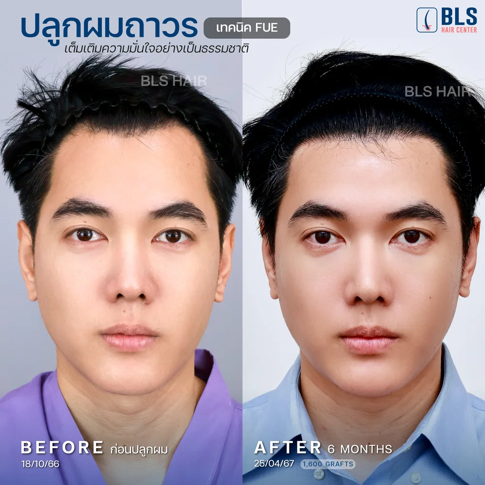 รีวิวปลูกผมผู้ชาย ผมบางกลับมาหนา ผลลัพธ์ธรรมชาติ ที่ BLS Hair Center