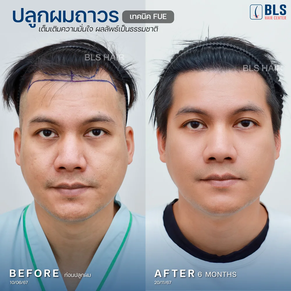 รีวิวปลูกผมผู้ชาย ผมบางกลับมาหนา ผลลัพธ์ธรรมชาติ ที่ BLS Hair Center