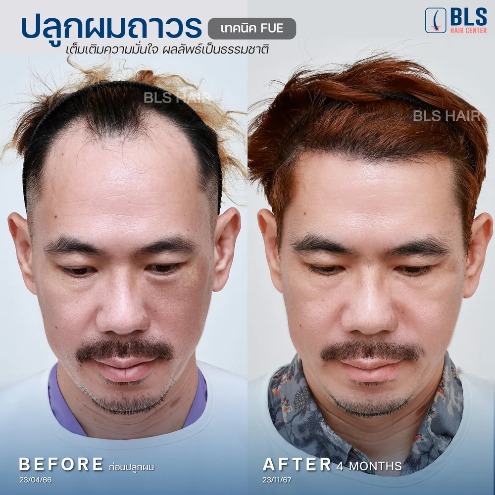 รีวิวปลูกผมผู้ชาย ผมบางกลับมาหนา ผลลัพธ์ธรรมชาติ ที่ BLS Hair Center