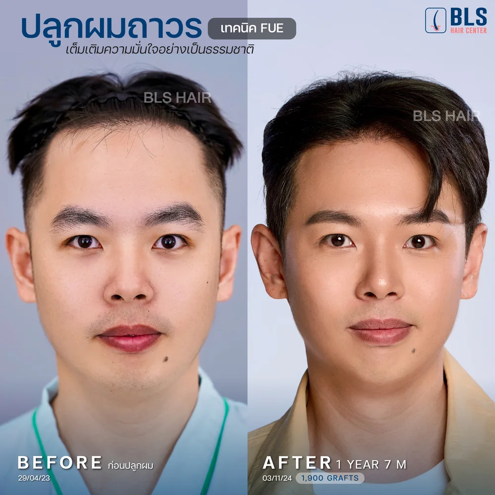 รีวิวปลูกผมผู้ชาย ผมบางกลับมาหนา ผลลัพธ์ธรรมชาติ ที่ BLS Hair Center