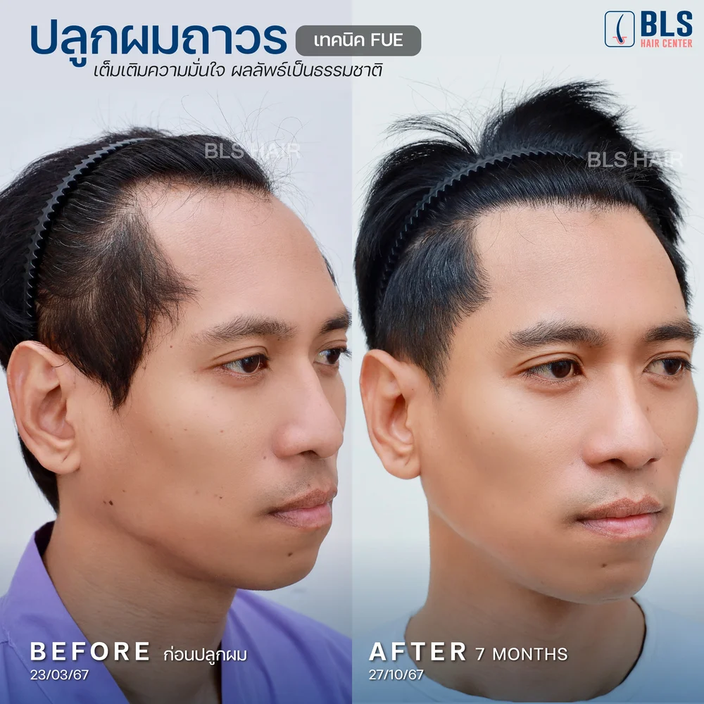 รีวิวปลูกผมผู้ชาย ผมบางกลับมาหนา ผลลัพธ์ธรรมชาติ ที่ BLS Hair Center