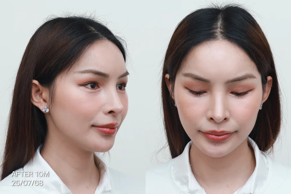 ปลูกผมถาวร ไรผมบาง Hair Transplant Clinic