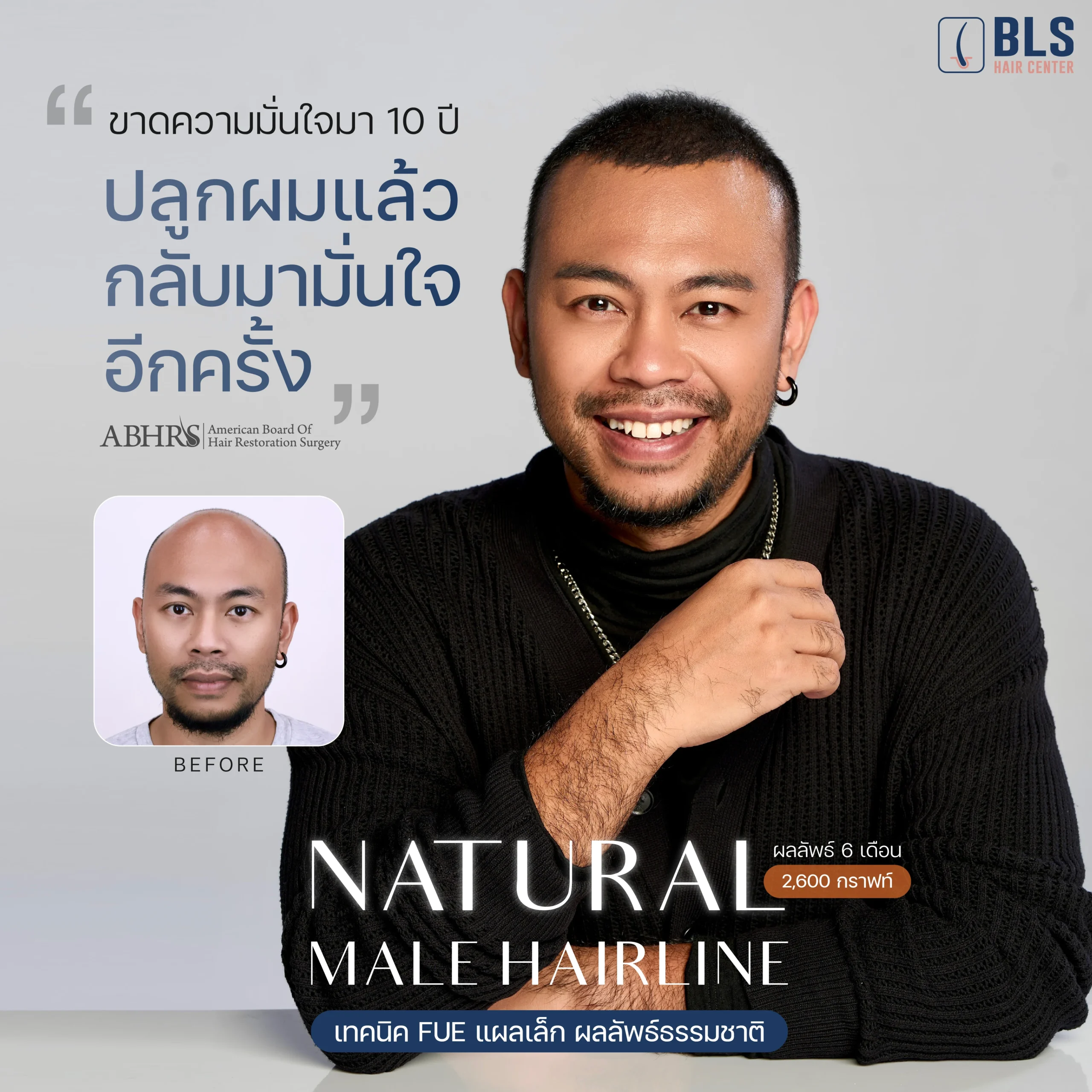 รีวิวปลูกผมถาวร ปลูกผม FUE hair transplant 