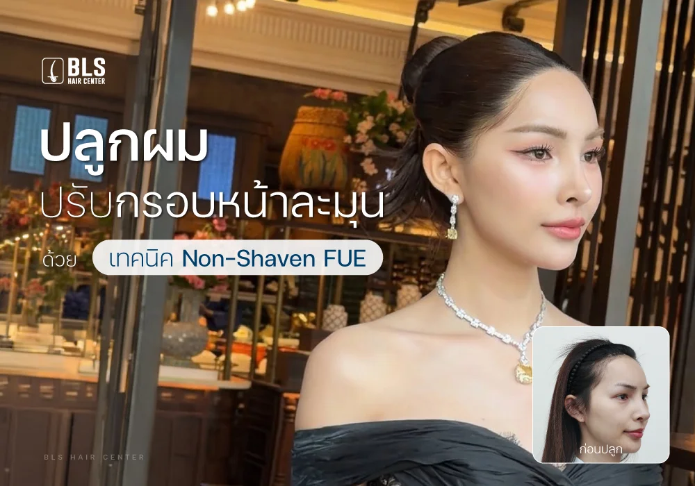 รีวิวปลูกผมปรับกรอบหน้าละมุน ด้วยเทคนิค Non-Shaven FUE
