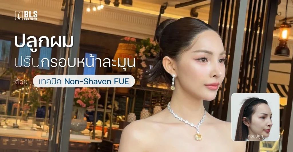 รีวิวปลูกผมปรับกรอบหน้าละมุน ด้วยเทคนิค Non-Shaven FUE