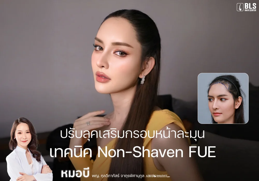 ปรับลุคเสริมกรอบหน้าละมุนด้วยเทคนิคปลูกผม Non-Shaven FUE