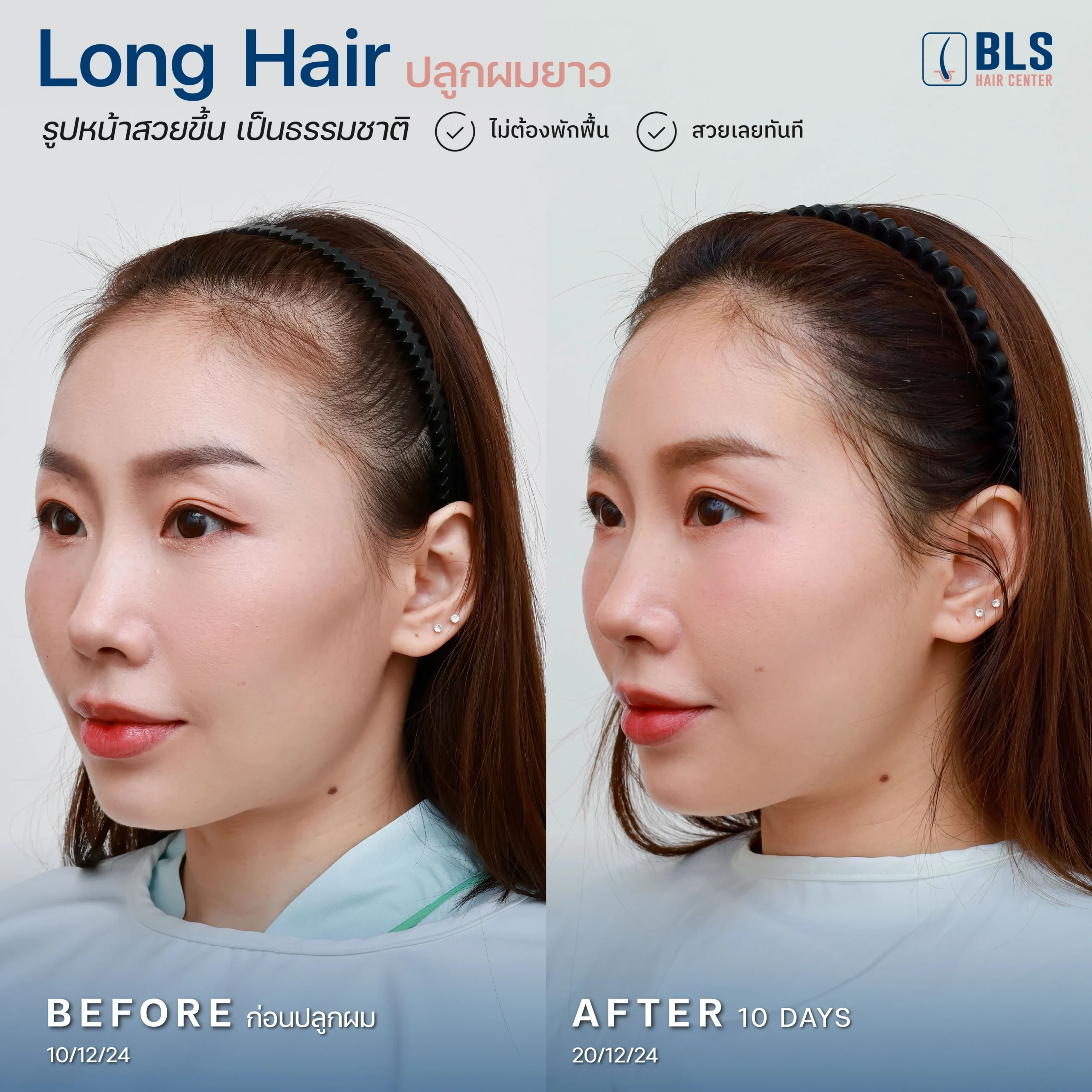 ปลูกผม Long Hair แก้ไรผมบาง กรอบหน้าสวยละมุน ดูธรรมชาติ