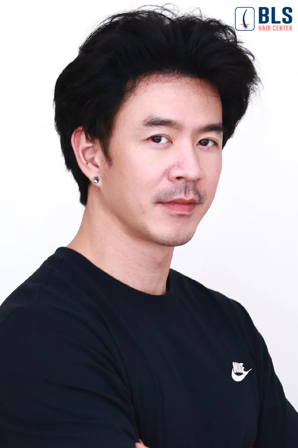 คุณอาร์ม ปลูกผมถาวร เทคนิค FUE