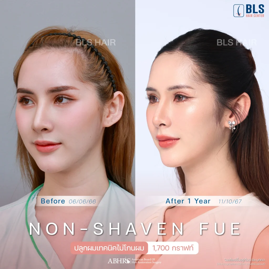 คุณวี ปลูกผมเทคนิคไม่โกนผม (Non-Shaven FUE) 