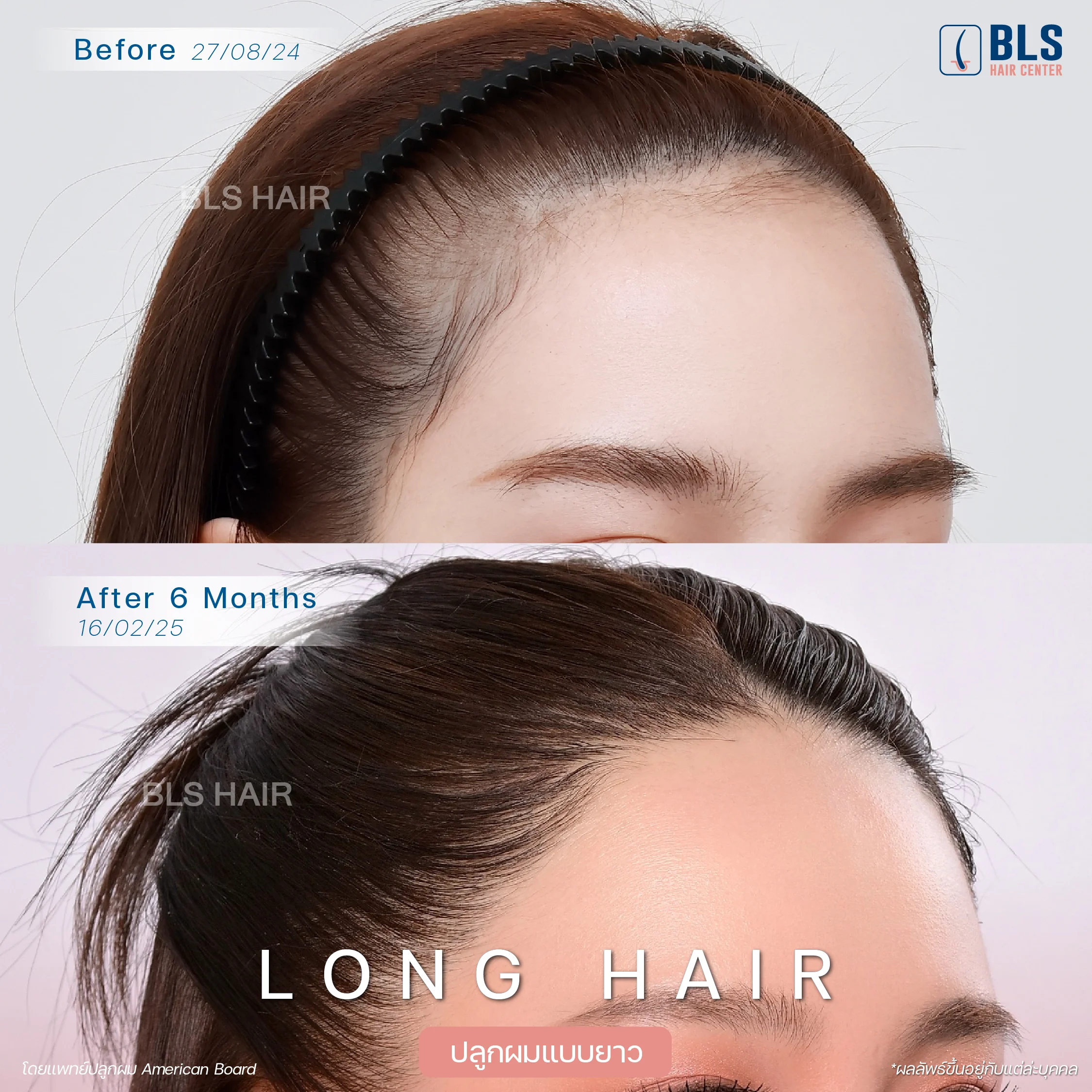 การปลูกผม Long Hair คืออะไร