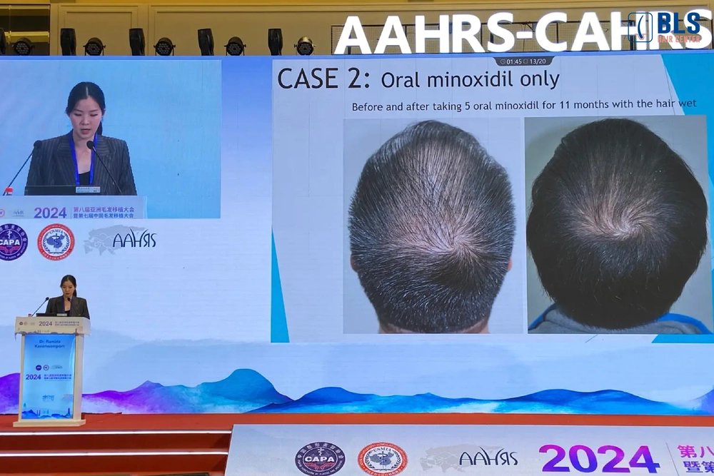 Excellent Speaker ในงานประชุมวิชาการของแพทย์ปลูกผมเอเชีย (AAHRS-CAHRS 2024) ประเทศจีน