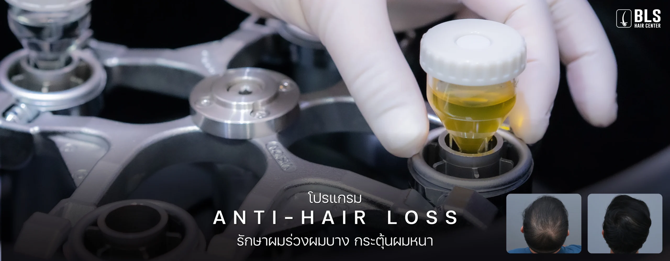 โปรแกรม Anti-Hair Loss รักษาผมร่วงผมบาง กระตุ้นผมหนา