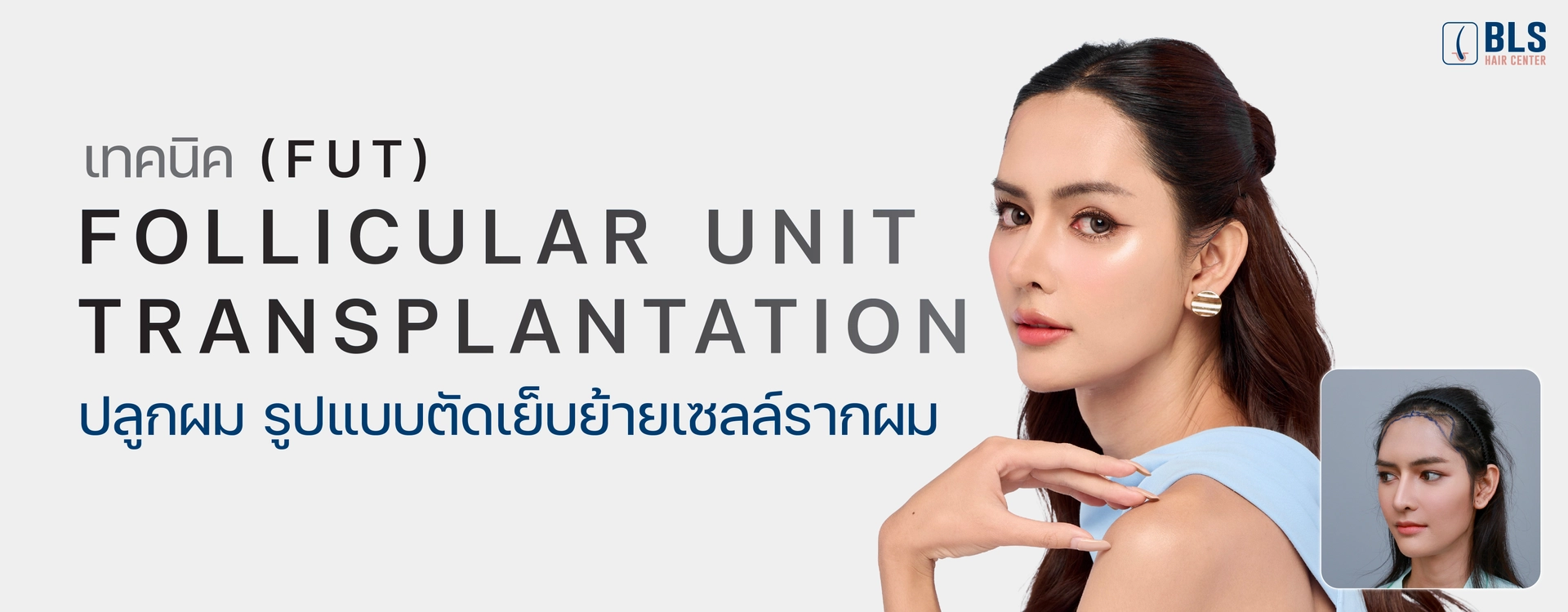 เทคนิค FUT (Follicular Unit Transplantation) ปลูกผม รูปแบบตัดเย็บย้ายเซลล์รากผม