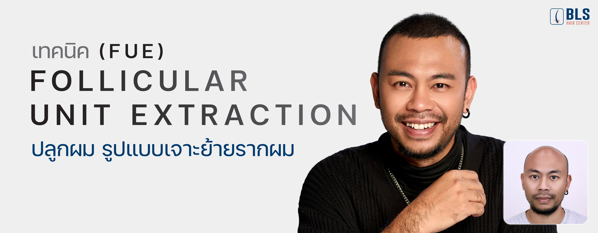 เทคนิค FUE (Follicular Unit Extraction) ปลูกผม รูปแบบเจาะย้ายรากผม