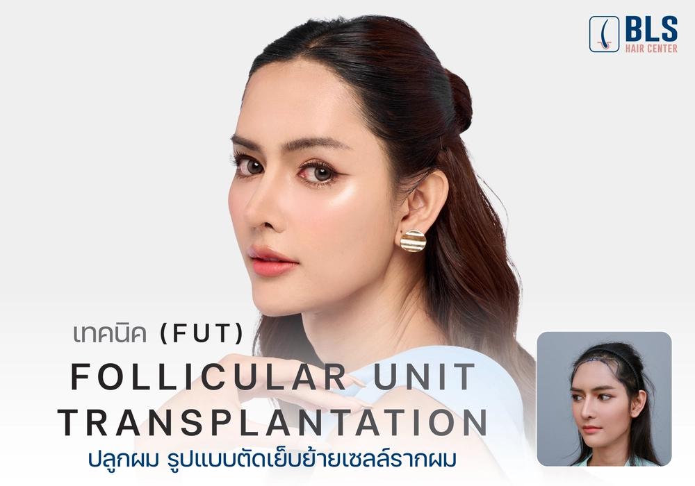ปลูกผม FUT (Follicular Unit Transplantation)