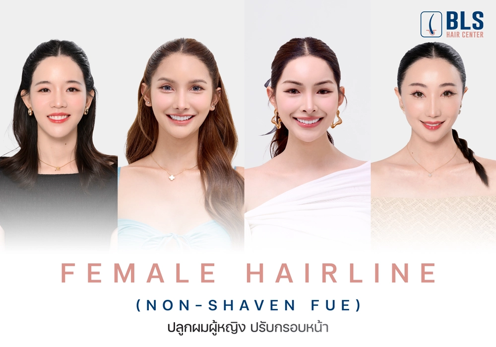 ปลูกผมผู้หญิง สร้างกรอบหน้าด้วย Hairline ดีไซน์แนวผมเพื่อผู้หญิงโดยเฉพาะ