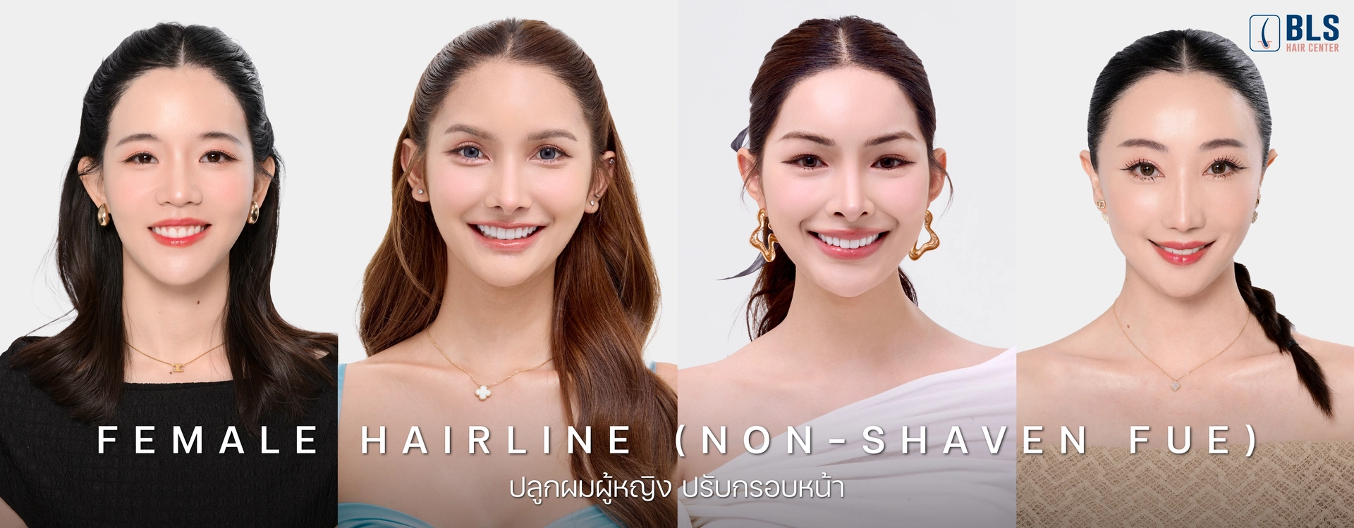 เทคนิค Female Hairline (Non-Shaven FUE) ปลูกผมผู้หญิง ปรับกรอบหน้า