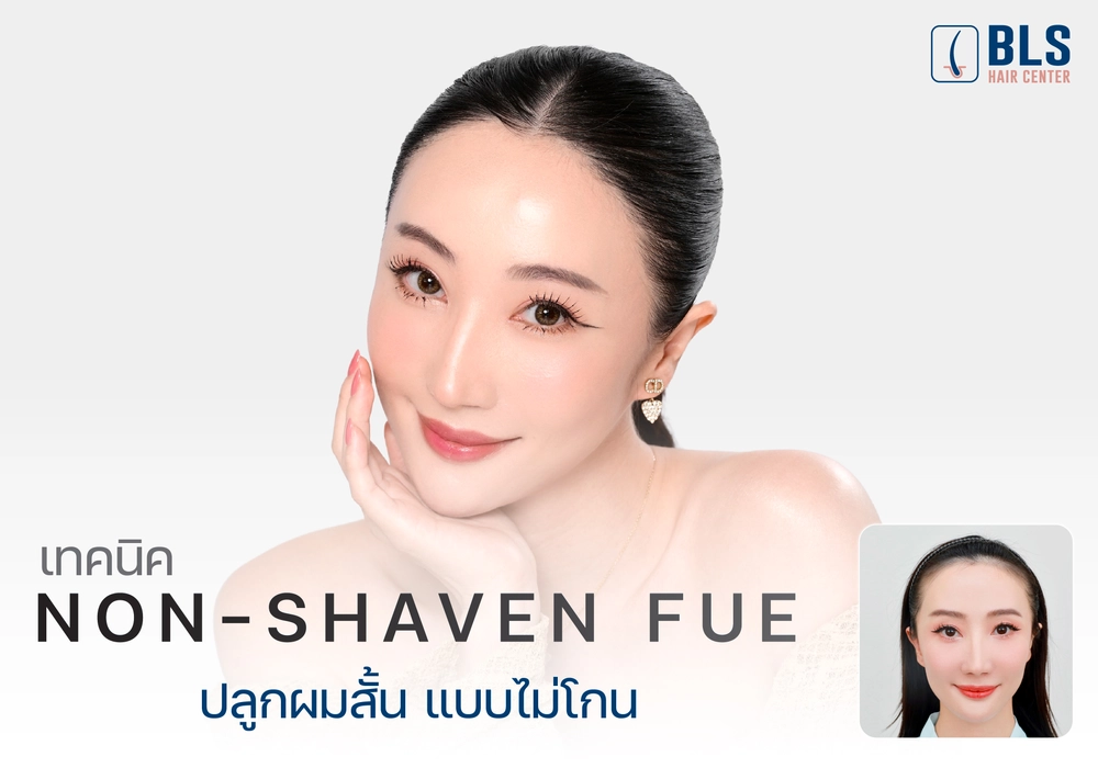 ปลูกผมไม่ต้องโกน Non Shaven FUE ผมเรียงเส้นสวย ไร้รอยแผล