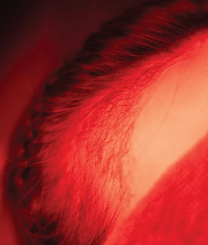 ฉายแสงกระตุ้นรากผม (LED Hair Growth) เทคนิคการฉายแสงกระตุ้นรากผม