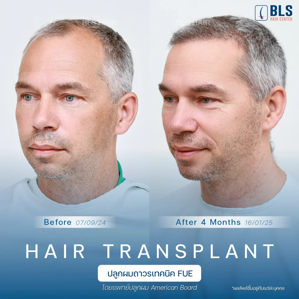 รวมรีวิวเคสปลูกผม ผลลัพธ์ดี แนวผมเป็นธรรมชาติ ที่ BLS Hair Center