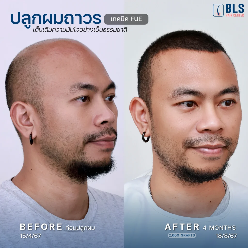 รวมรีวิวเคสปลูกผม ผลลัพธ์ดี แนวผมเป็นธรรมชาติ ที่ BLS Hair Center