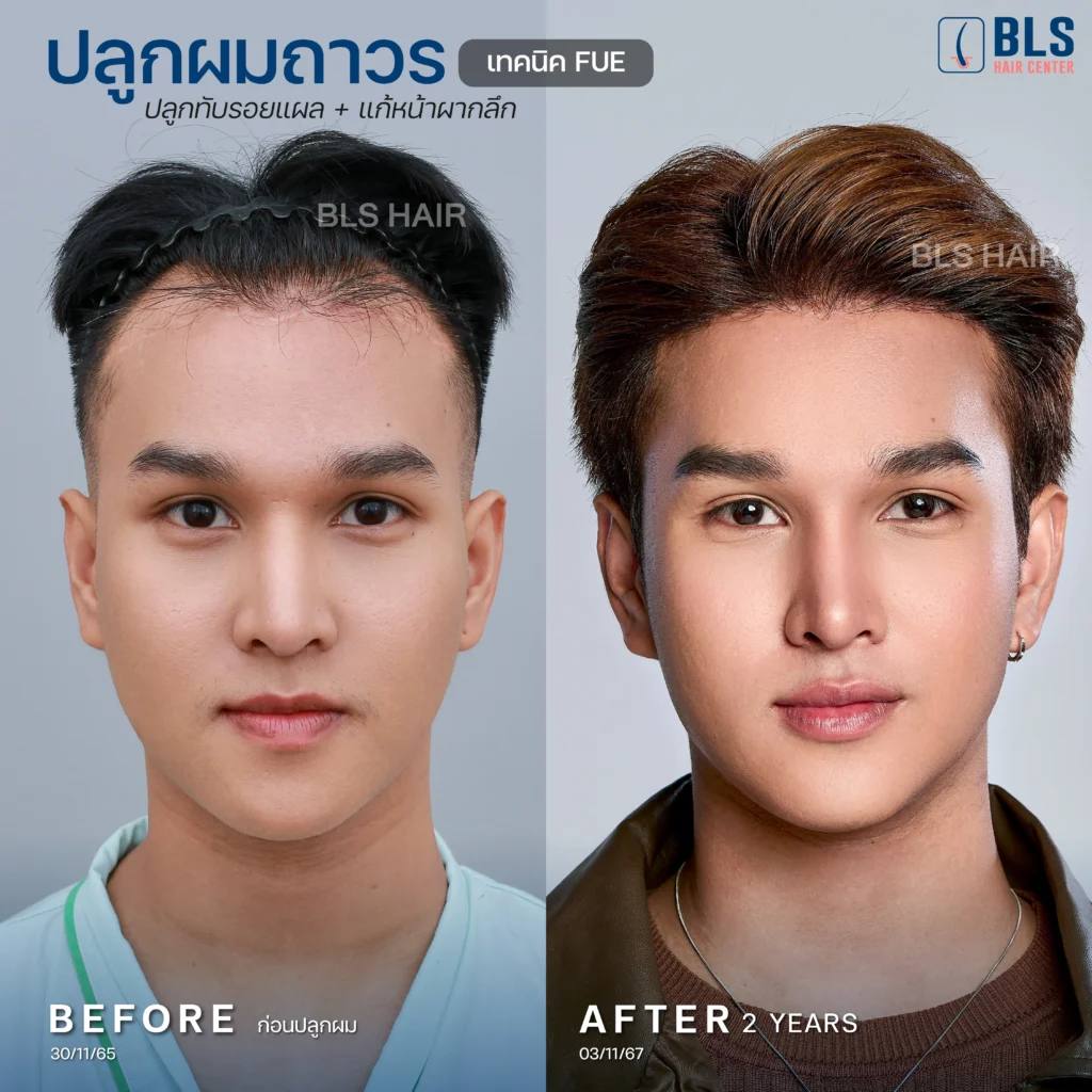 รวมรีวิวเคสปลูกผม ผลลัพธ์ดี แนวผมเป็นธรรมชาติ ที่ BLS Hair Center