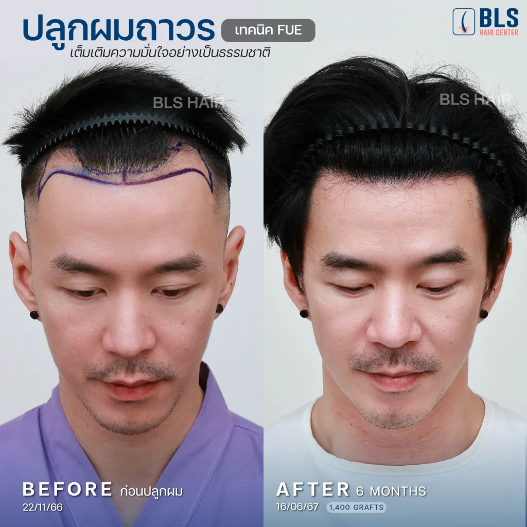 รีวิวปลูกผมเทคนิค FUE (Follicular Unit Extraction) ร่วมกับปลูกผมทับ Scar