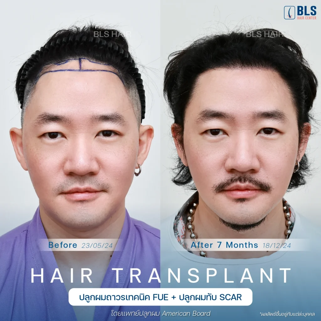 รีวิวปลูกผมเทคนิค FUE (Follicular Unit Extraction) ร่วมกับปลูกผมทับ Scar