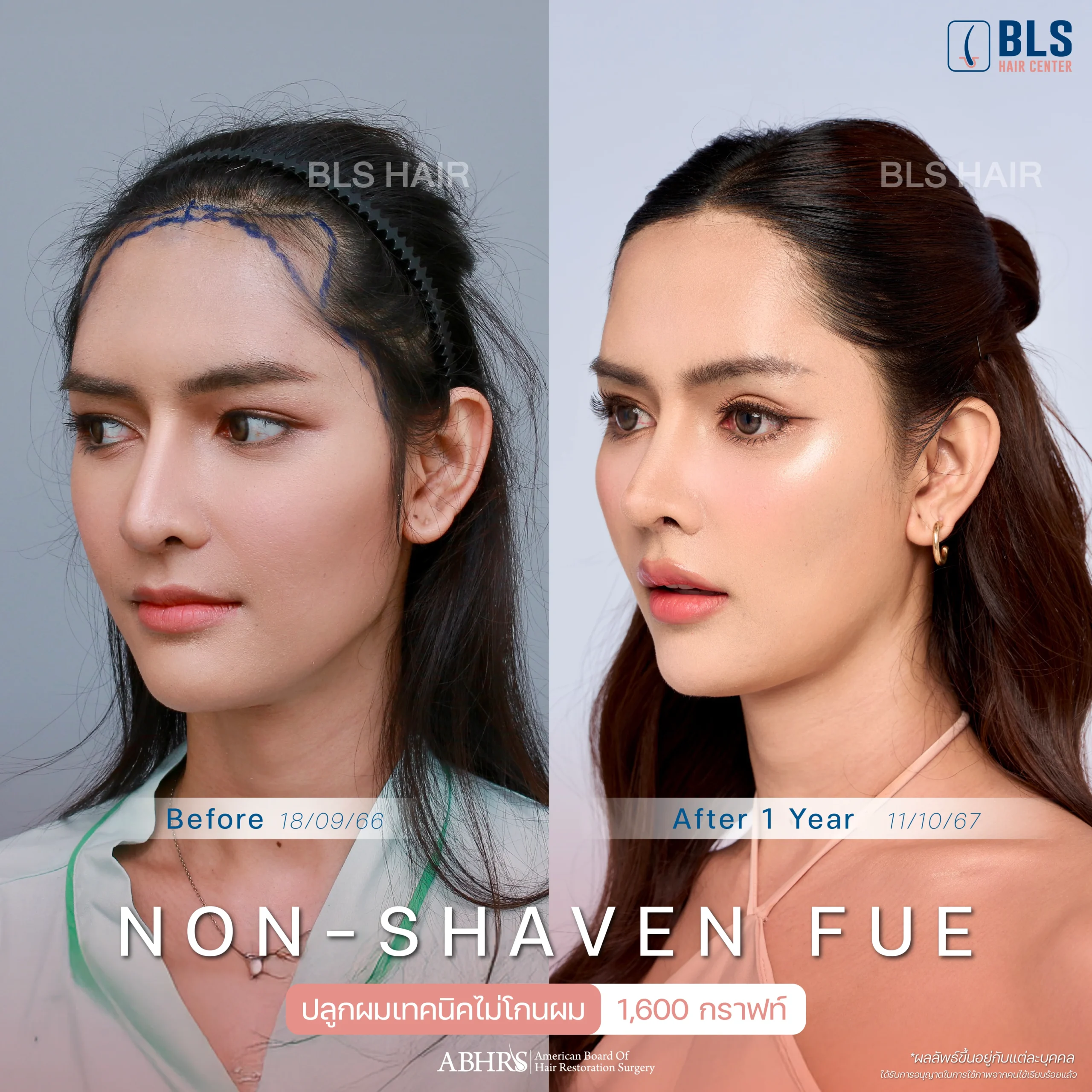  รีวิวปลูกผมเทคนิค FUT (Follicular Unit Transplantation)