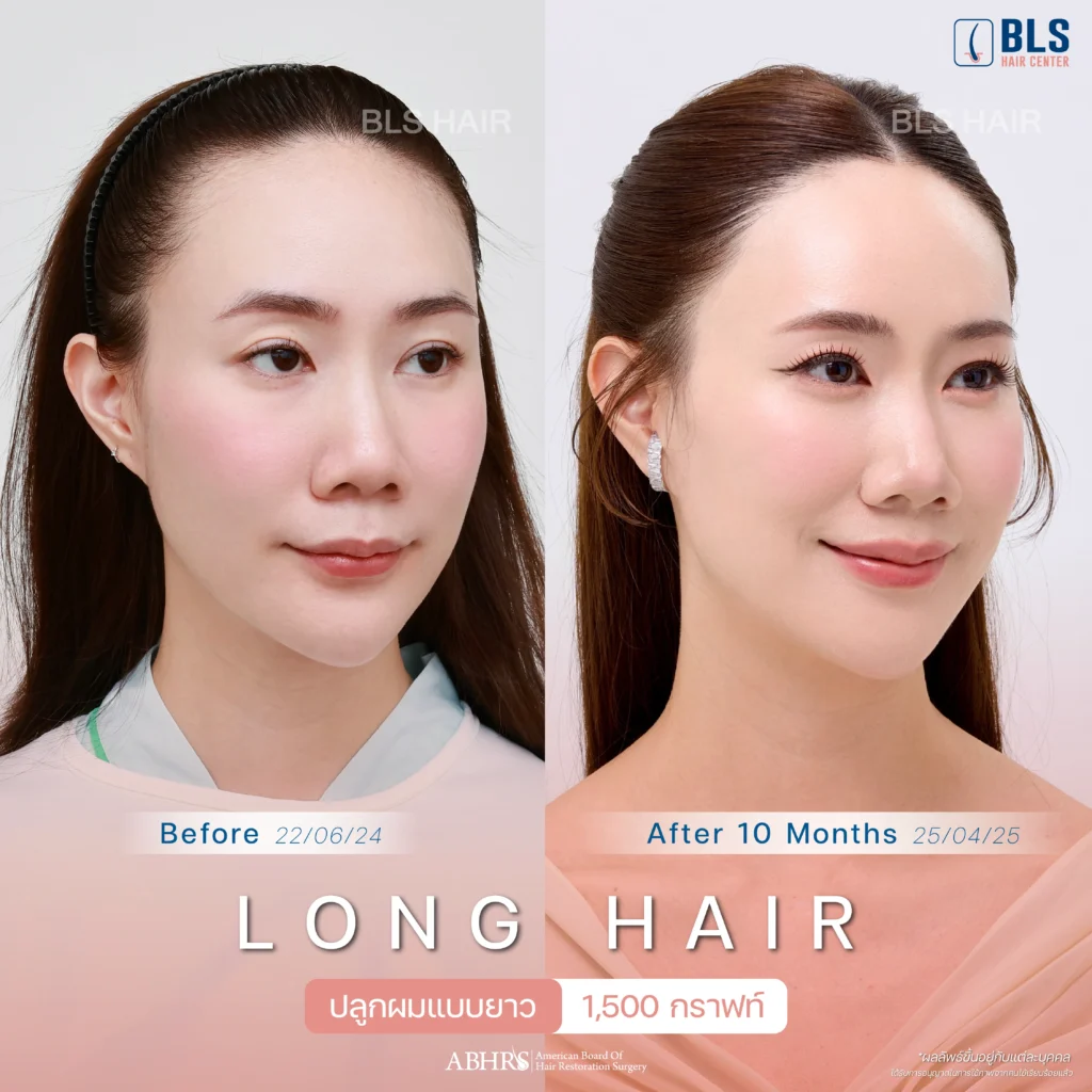 รีวิวปลูกผมเทคนิค Long Hair (FUE) ปลูกผมยาว แบบไม่โกน