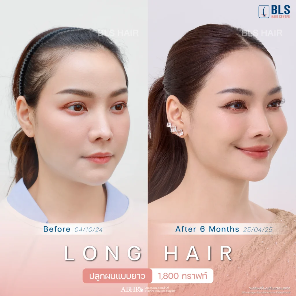 รีวิวปลูกผมเทคนิค Long Hair (FUE) ปลูกผมยาว แบบไม่โกน